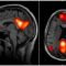 Default mode network brain scan