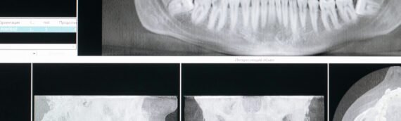 Hypnotherapy for Bruxism. Is Hypnosis An Effective Treatment for Teeth Grinding?