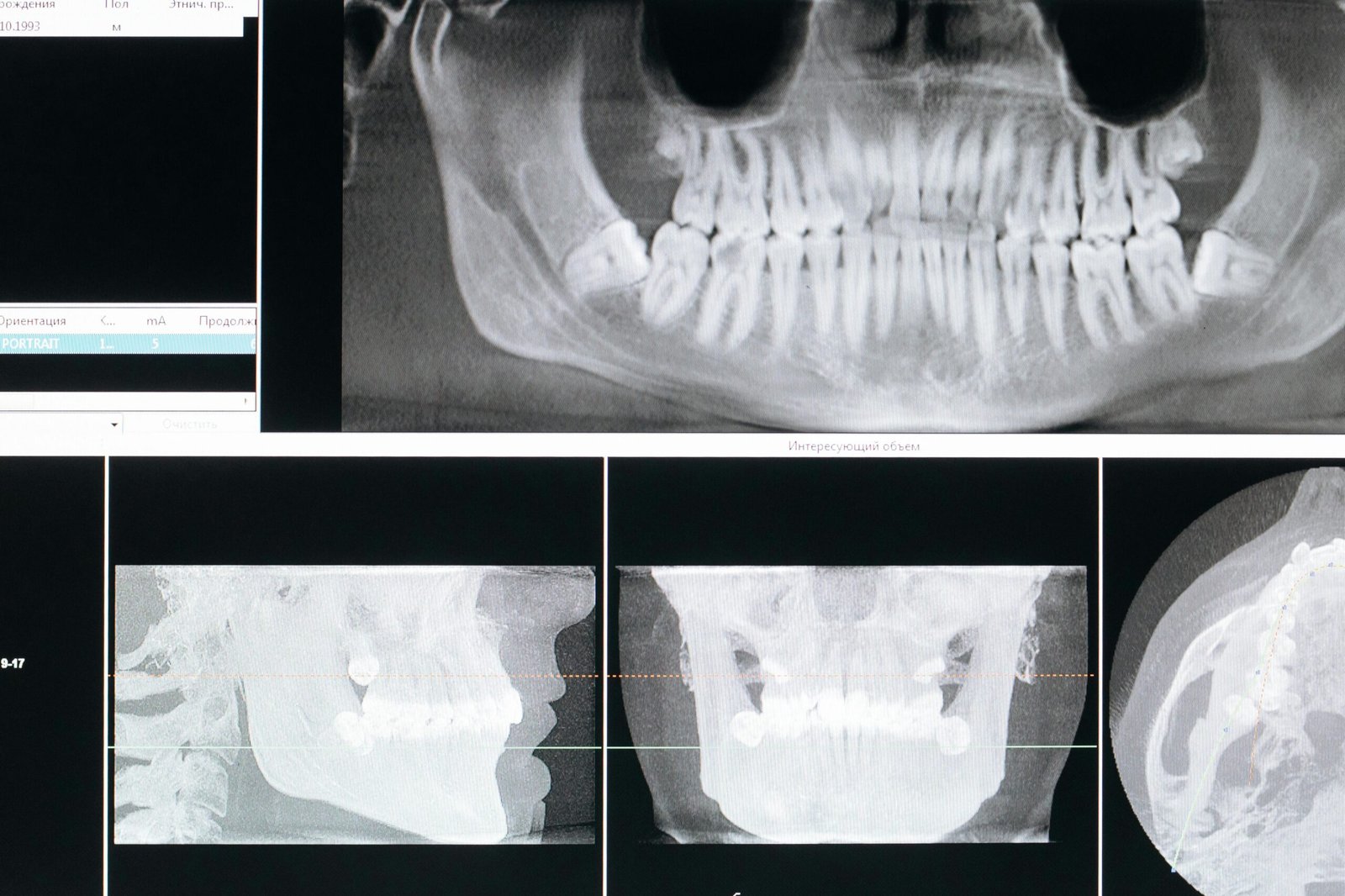 clenched teeth x-ray bruxism